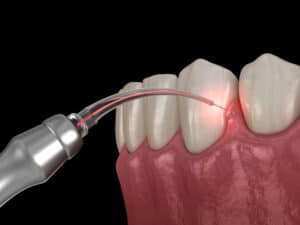 laser dentistry von chan dds dentist in petaluma ca